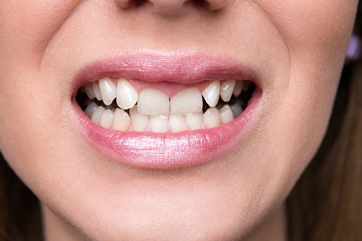 Crooked teeth