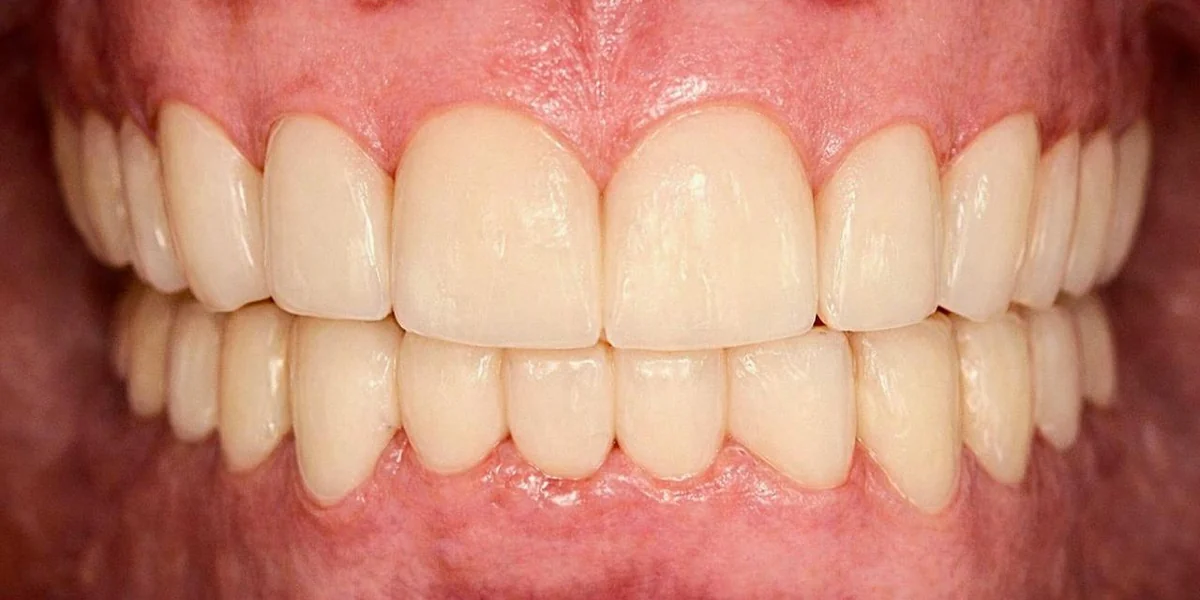 Smile Rehabilitation with Crowns — after treatment