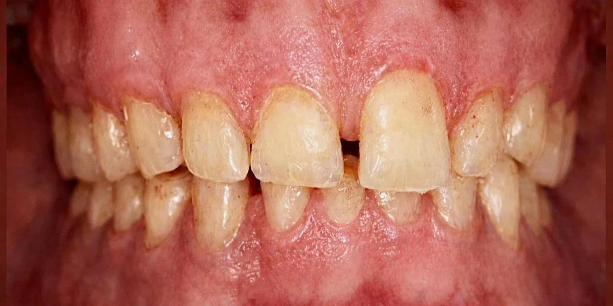 Smile Rehabilitation with Crowns — before treatment