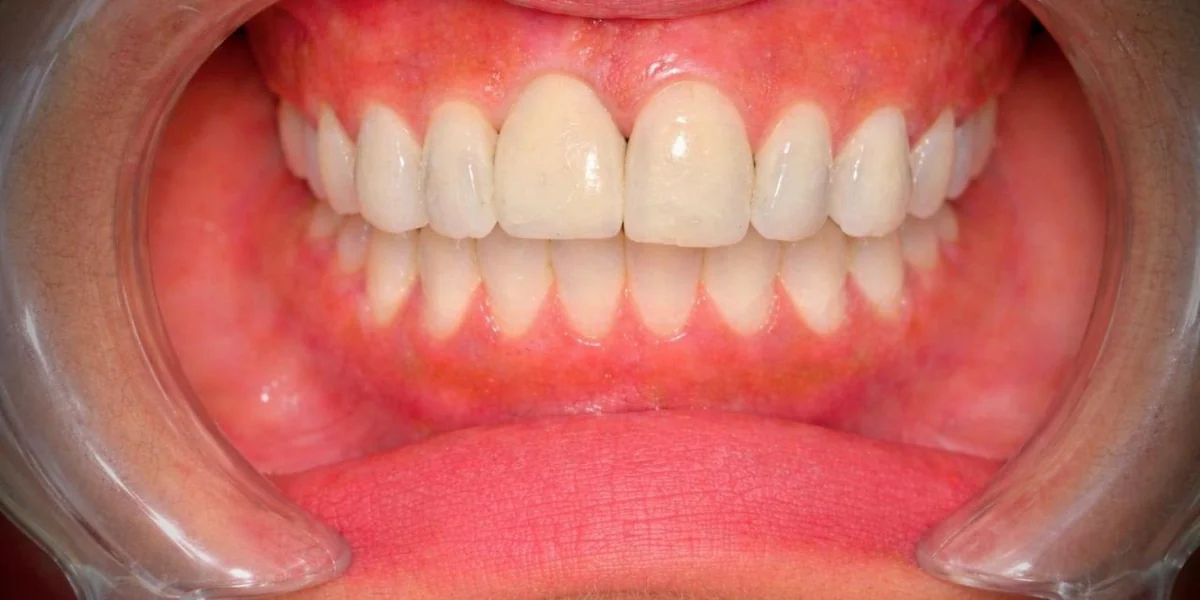Single Tooth Implant — after treatment
