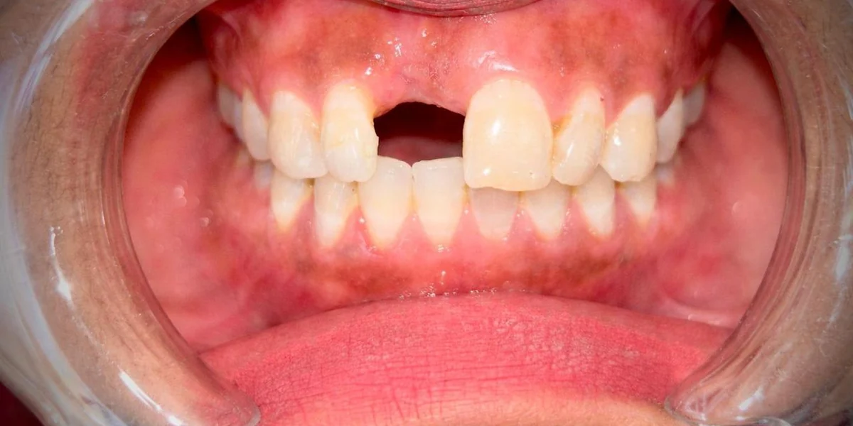 Single Tooth Implant — before treatment