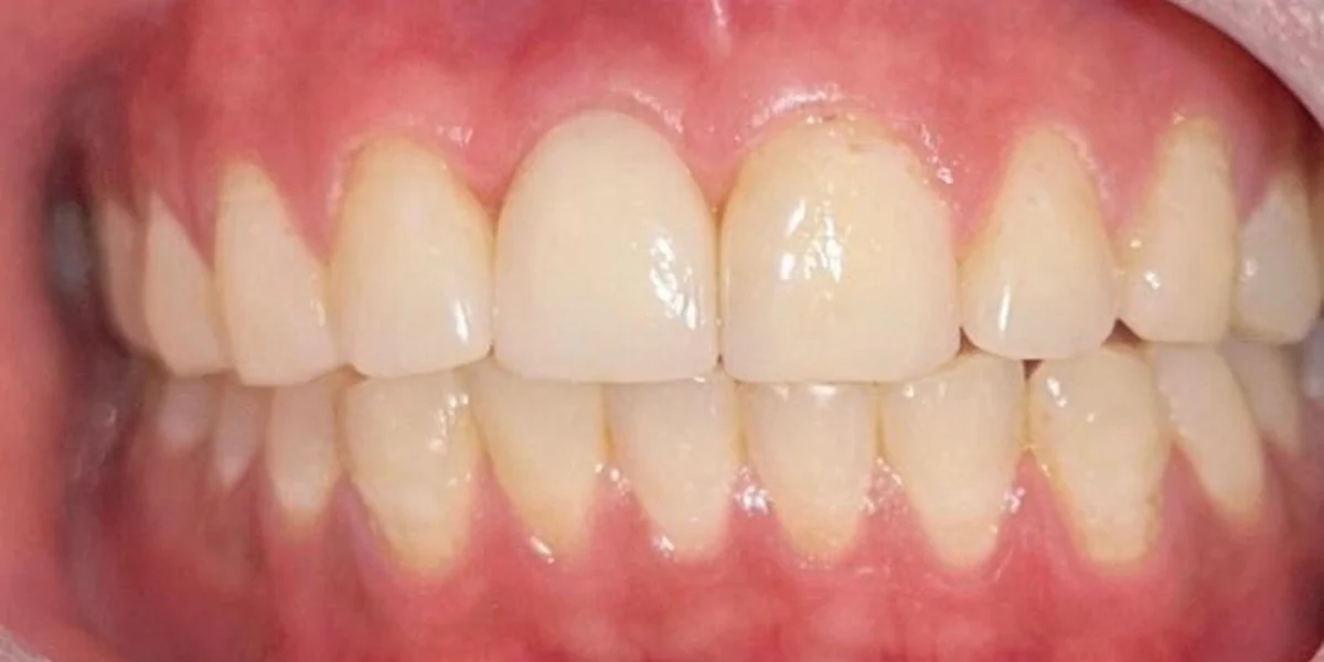 Implant Crown — Upper Front Tooth — after treatment