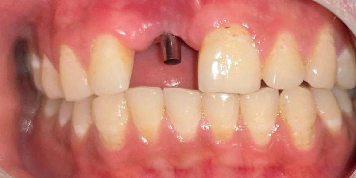 Implant Crown — Upper Front Tooth — before treatment