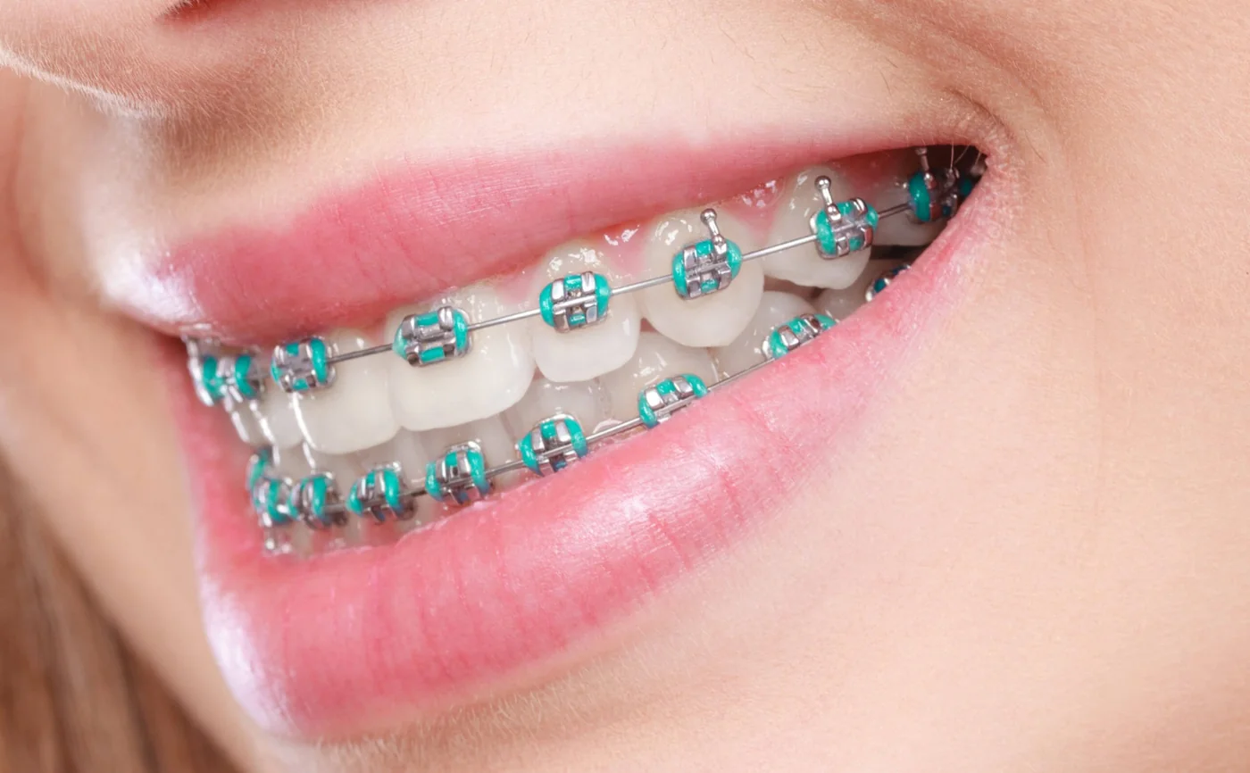 Braces Treatment