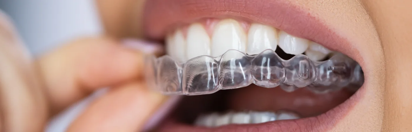 Clear Aligners
